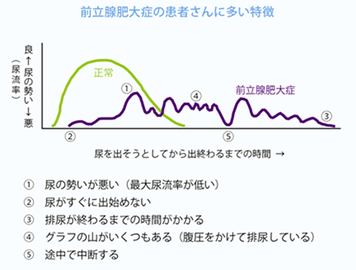 前立腺肥大症の患者さんに多い特徴